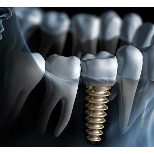 Dental Implants Dental Implants