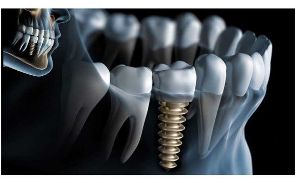 Dental Implants Dental Implants