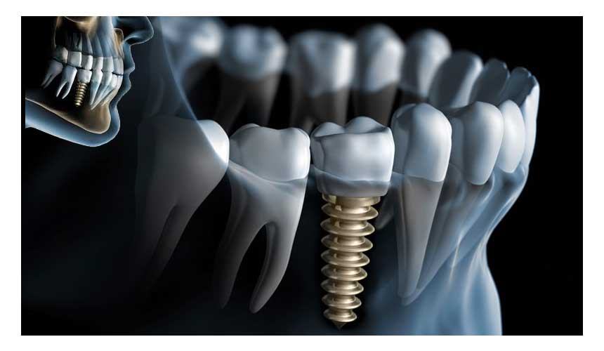 Dental Implants Dental Implants